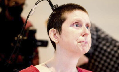 This photo provided by researchers at UCSF and UC Berkeley shows Ann, a participant in a study on speech neuroprostheses, in California in 2023. (Noah Berger/UCSF, UC Berkeley via AP)