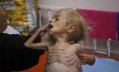 APTOPIX Mideast Wars Gaza Hunger