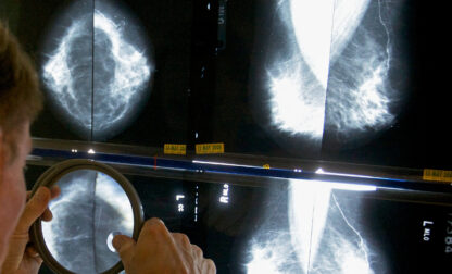 Mammograms After Cancer