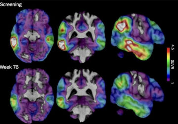 Alzheimers New Experimental Drugs