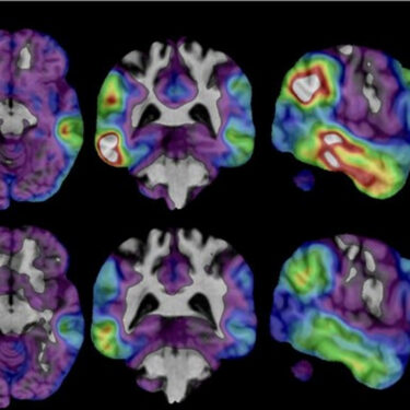 Alzheimers New Experimental Drugs