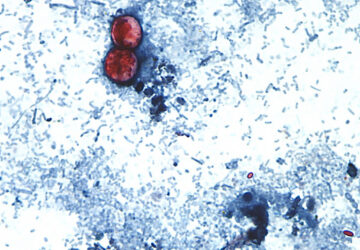 Cyclospora Outbreak